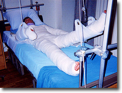body cast
